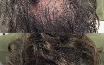 Fortalecer el cabello con mesoterapia: Cuidado personalizado en Andalucía