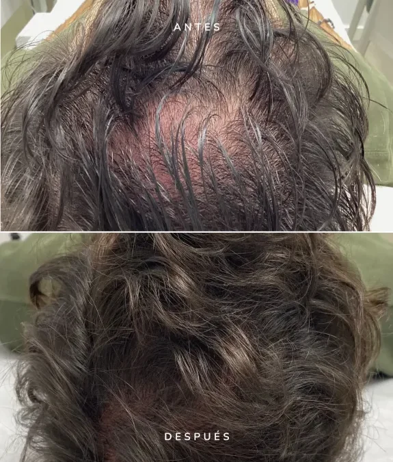 Fortalecer el cabello con mesoterapia: Cuidado personalizado en Andalucía