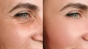 Neuromoduladores: equilibrio, expresión y belleza natural con criterio médico